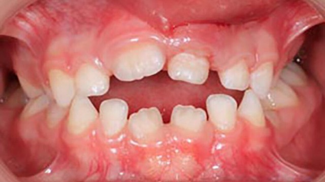 bai-viet/tac-hai-cua-tat-day-luoi-la-gi.html