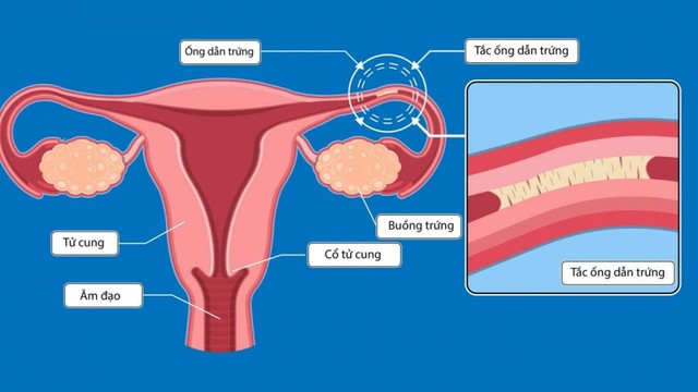 bai-viet/tac-voi-trung-co-lam-iui-duoc-khong-nhung-dieu-ban-can-biet.html