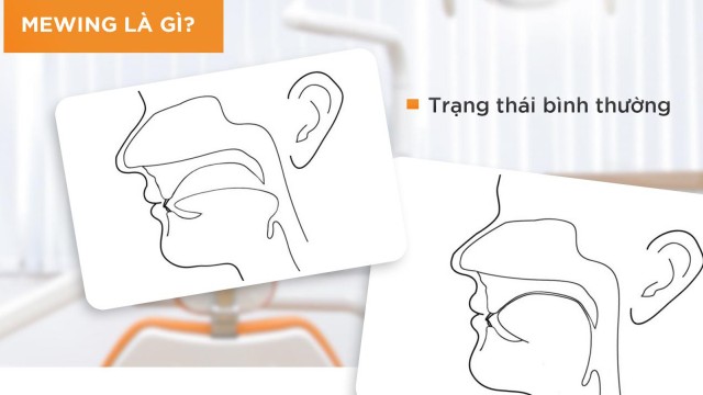 bai-viet/tap-luyen-ky-thuat-mewing-co-giup-mui-nho-lai-khong-hay-chi-la-ngo-nhan-65154.html