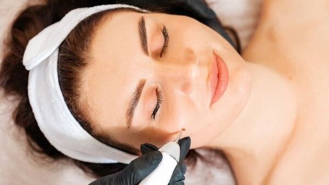 bai-viet/tay-not-ruoi-bao-nhieu-tien-cach-cham-soc-da-chuan-y-khoa-sau-khi-tay-not-ruoi.html