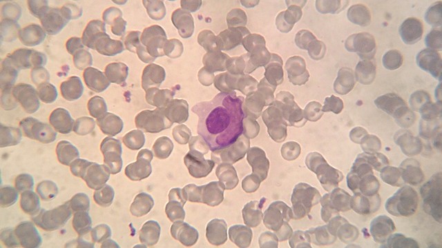 bai-viet/vai-tro-cua-xet-nghiem-te-bao-hargraves.html