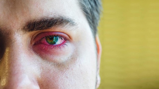 bai-viet/thac-mac-tai-sao-deo-lens-bi-cay-mat-57114.html