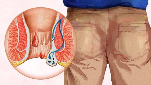 bai-viet/that-tri-bao-lau-thi-rung-mot-so-dieu-nguoi-benh-can-luu-y-sau-khi-that-tri.html