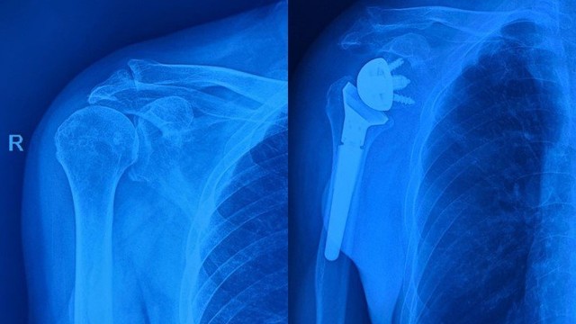 bai-viet/thay-khop-vai-la-gi-khi-nao-can-thuc-hien-phau-thuat-thay-khop-vai.html