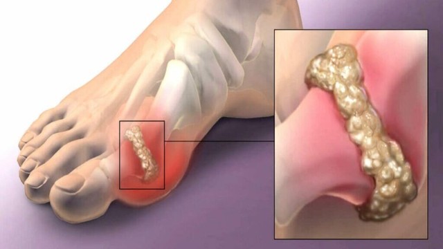 bai-viet/the-nao-duoc-xem-la-tang-acid-uric-mau-khong-trieu-chung.html