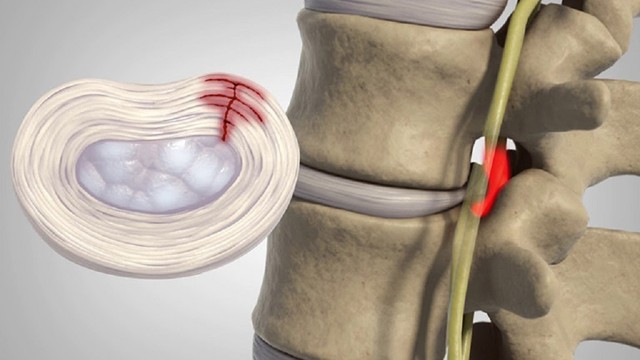 bai-viet/thoat-vi-dia-dem-noi-xop-la-benh-gi-cach-phong-tranh-va-dieu-tri.html