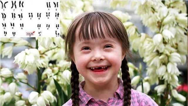 bai-viet/hoi-chung-down-thai-nhi-la-gi-hoi-chung-down-thai-nhi-do-dau.html