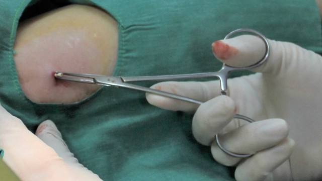 bai-viet/thoi-diem-quy-trinh-va-kha-nang-mang-thai-sau-khi-thao-que-tranh-thai-nguoi-dung-nen-biet.html