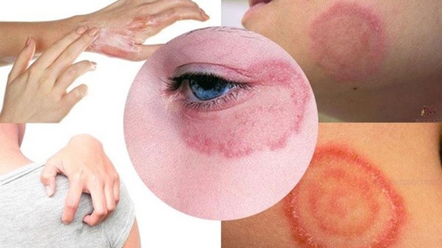 bai-viet/thoi-gian-hac-lao-u-benh-bao-lau-can-luu-y-dieu-gi-55509.html