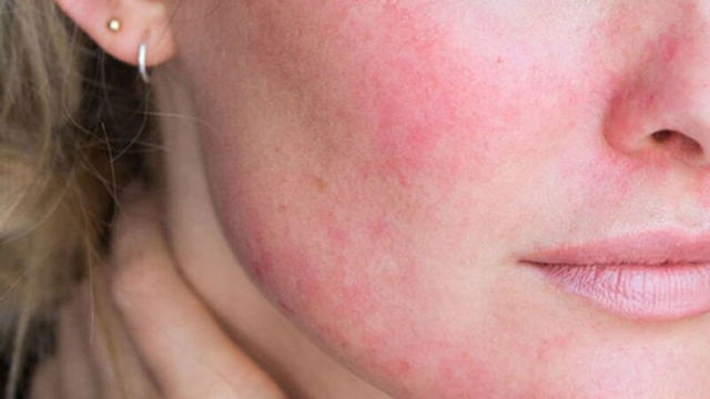 bai-viet/thong-tin-can-biet-ve-viem-mo-te-bao-vung-mat-59392.html