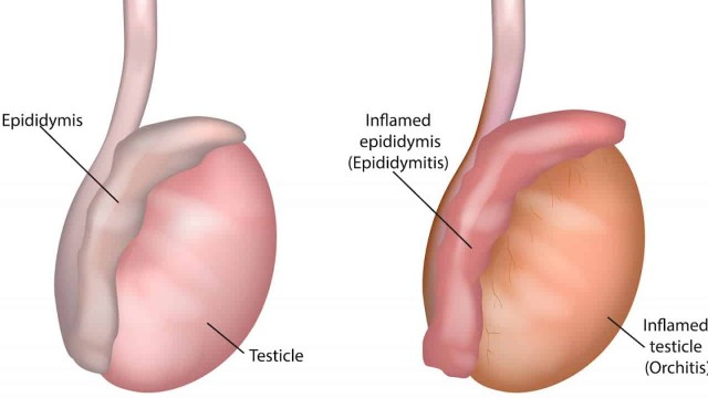 bai-viet/thong-tin-nam-gioi-can-biet-viem-mao-tinh-hoan-co-nguy-hiem-khong.html