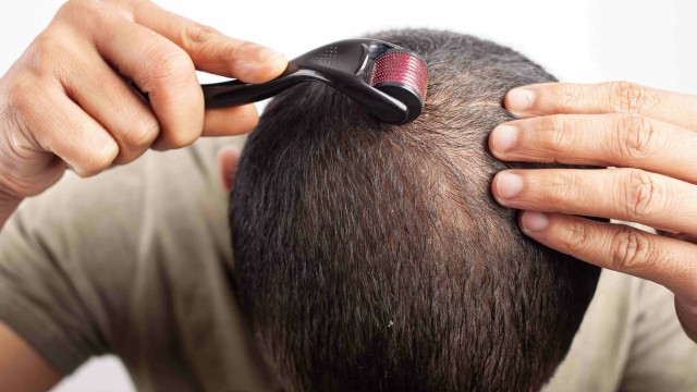 bai-viet/phuong-phap-lan-kim-moc-toc-co-thuc-su-hieu-qua-khong.html