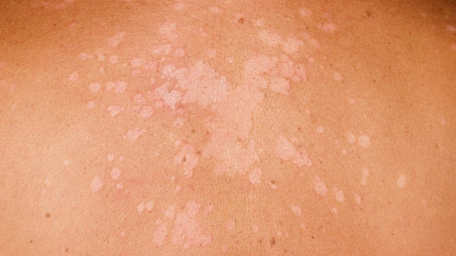 bai-viet/thuoc-boi-dieu-tri-lang-ben-dien-rong-53589.html