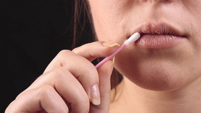 bai-viet/thuoc-boi-herpes-moi-nao-tot-nhat-hien-nay-58785.html