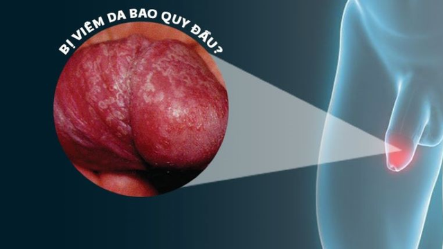 bai-viet/thuoc-boi-viem-bao-quy-dau-dung-nhu-the-nao.html