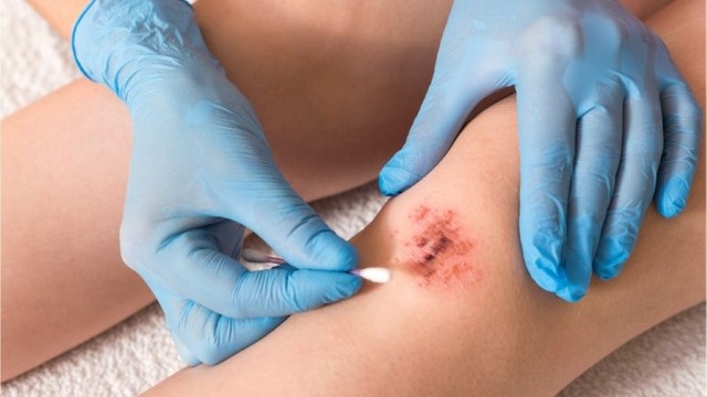 bai-viet/thuoc-mo-khang-sinh-boi-vet-thuong-ho-va-nhung-dieu-ban-can-biet.html