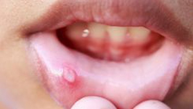 bai-viet/thuoc-oracortia-co-dung-duoc-cho-tre-em-khong-va-nen-dung-thuoc-an-toan-cho-tre-the-nao.html