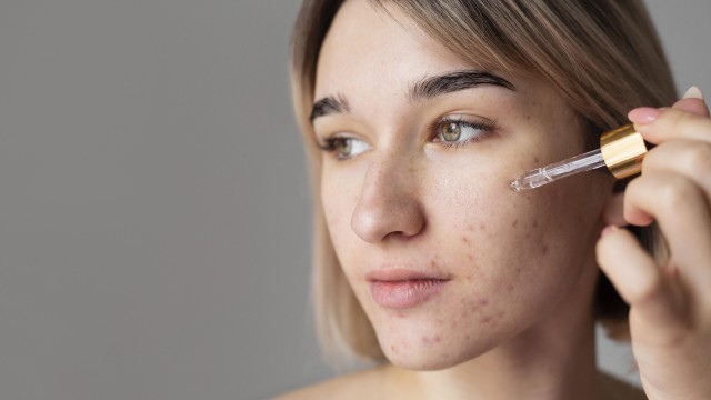 bai-viet/thuoc-tri-mun-coc-acid-salicylic-co-tot-khong-chi-dinh-va-lieu-dung-61129.html