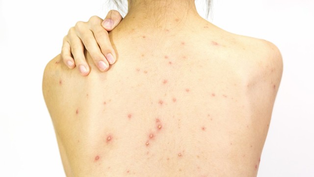 bai-viet/mot-so-thuoc-tri-mun-lung-o-tiem-thuoc-tay.html