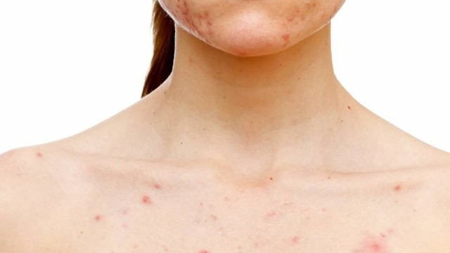 bai-viet/thuoc-tri-nam-nizoral-cream-tri-mun-duoc-khong-cac-luu-y-khi-dieu-tri-mun-ma-ban-nen-biet.html