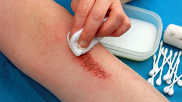 bai-viet/thuoc-xanh-methylen-boi-vet-thuong-ho-cach-dung-thuoc-hieu-qua-nhat.html