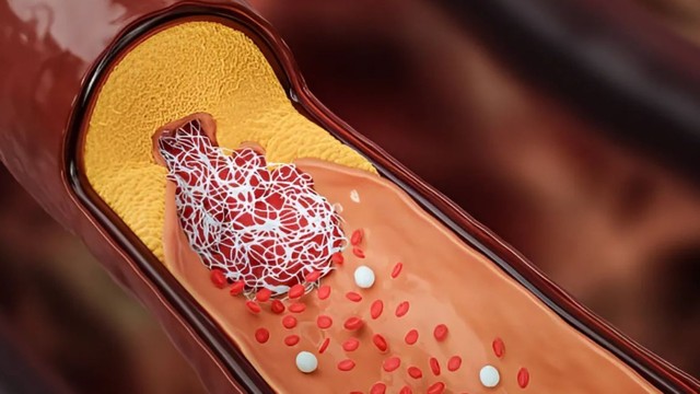 bai-viet/hoi-chung-thuyen-tac-mo-tong-quan-co-che-benh-sinh-bieu-hien-lam-sang-va-huong-dieu-tri.html