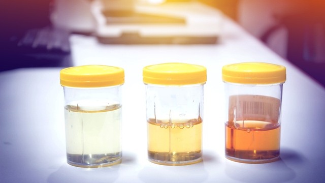 bai-viet/nuoc-tieu-mau-vang-dam-co-sao-khong.html