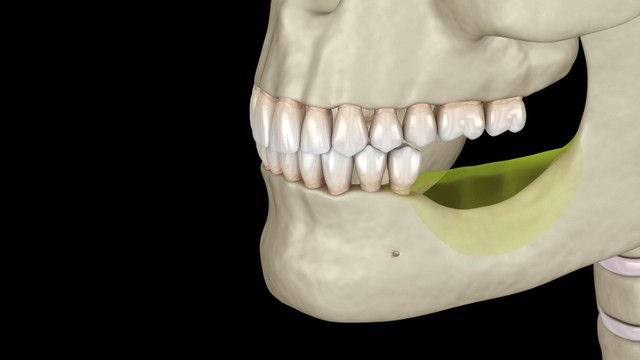  Tiêu xương hàm: Nguyên nhân, triệu chứng, phương pháp điều trị