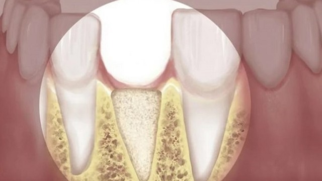 bai-viet/tieu-xuong-rang-nguy-hiem-nhu-the-nao-den-suc-khoe-72962.html