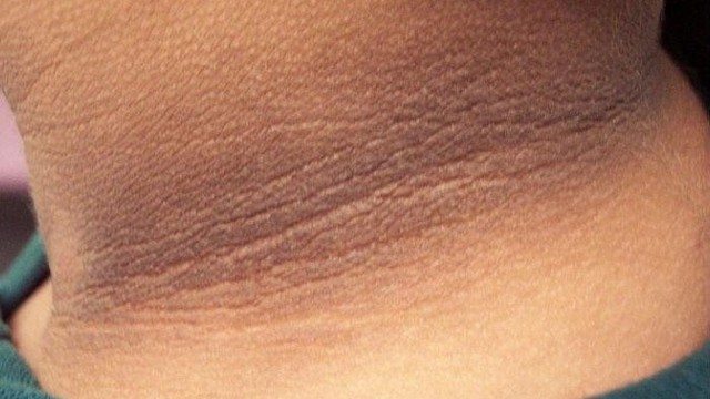 bai-viet/tim-hieu-benh-gai-den-o-nguoi-tieu-duong.html