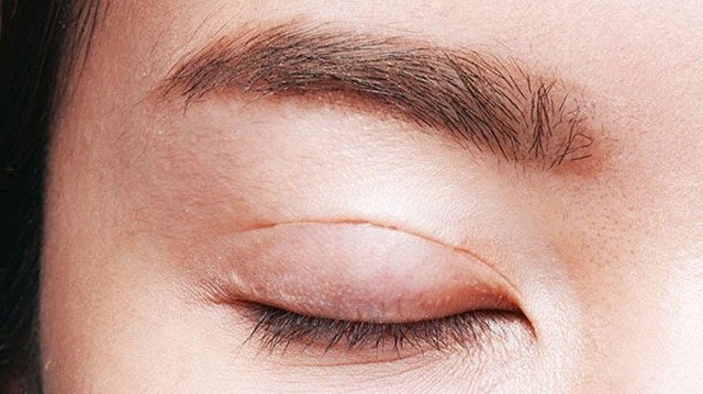 bai-viet/tim-hieu-ngay-ve-cac-phuong-phap-phau-thuat-nang-co-mi-mat.html