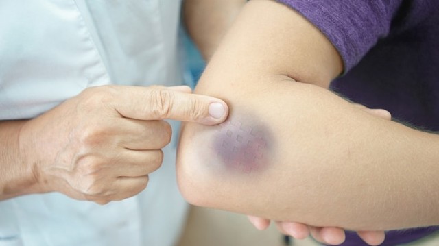 bai-viet/tim-hieu-o-tu-mau-nguyen-nhan-trieu-chung-va-bien-phap-phong-tranh.html