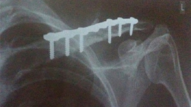 bai-viet/tim-hieu-phau-thuat-mo-rut-dinh-bao-lau-thi-di-duoc.html