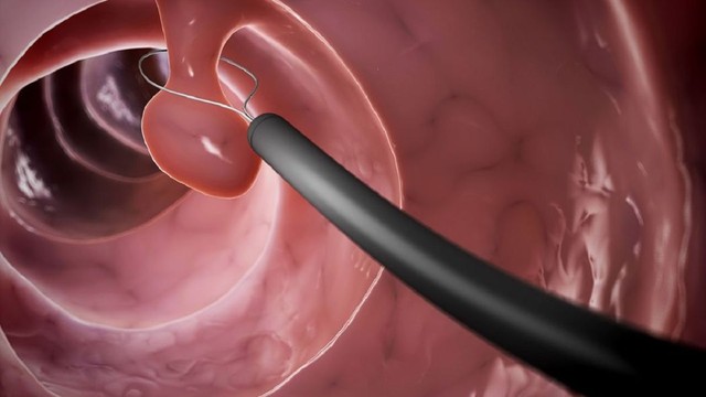 bai-viet/tim-hieu-u-tuyen-ong-nghich-san-do-thap-la-gi.html