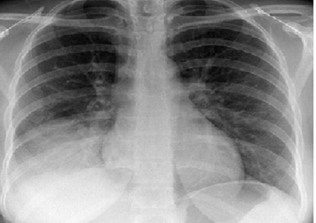 bai-viet/tim-hieu-ve-hoi-chung-dong-dac-phoi.html