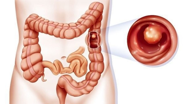 bai-viet/tim-hieu-ve-hoi-chung-polyp-hon-hop-di-truyen-54027.html