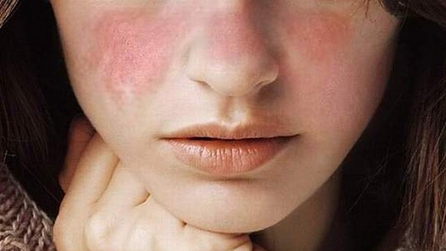 bai-viet/tim-hieu-ve-lupus-ban-do-he-thong-man-tinh-57111.html