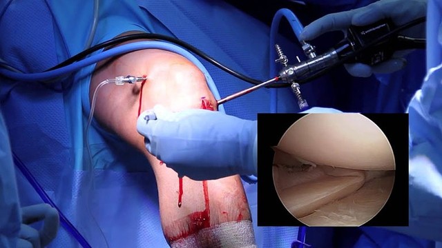 bai-viet/tim-hieu-ve-phau-thuat-rach-sun-chem-58737.html