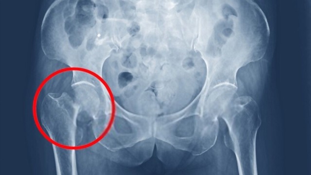 bai-viet/co-nen-thay-khop-hang-o-nguoi-gia-bi-gay-co-xuong-dui-khong.html