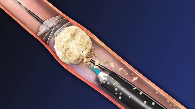 bai-viet/tim-hieu-ve-tan-soi-than-qua-da-phuong-phap-dieu-tri-soi-than.html