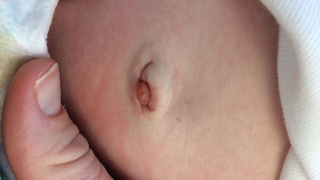 Tồn tại ống niệu rốn: Nguyên nhân, triệu chứng và cách điều trị