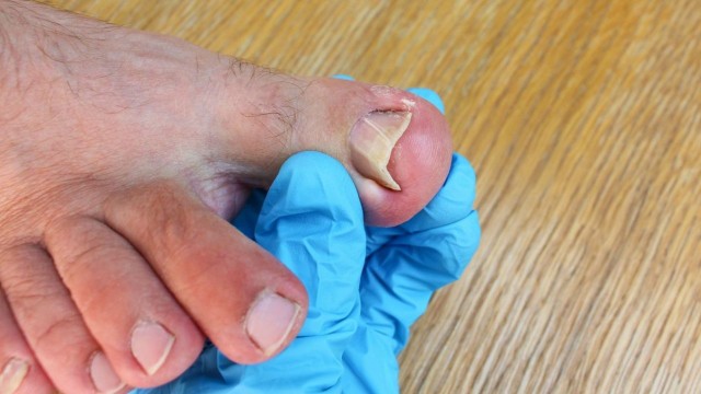 bai-viet/tinh-trang-mong-chan-moc-nguoc-dam-vao-thit-la-nhu-the-nao.html