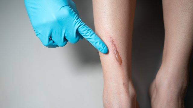 benh/to-dia-533.html