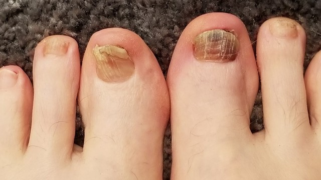 bai-viet/tong-hop-15-loai-thuoc-tri-nam-mong-chan-hieu-qua-1.html