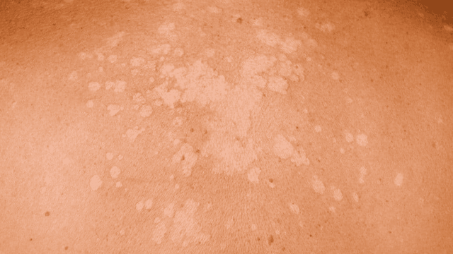 bai-viet/tong-hop-5-benh-nam-da-thuong-gap-va-cach-phong-ngua.html