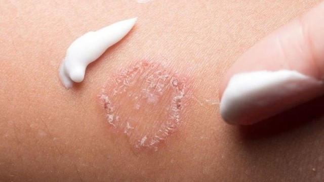 bai-viet/tong-hop-cac-loai-thuoc-boi-tri-hac-lao-o-mong-pho-bien-nhat-hien-nay-55127.html