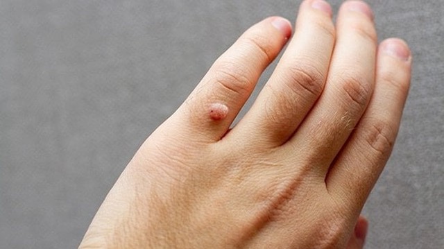 bai-viet/tong-hop-nhung-cach-tri-mun-com-tai-nha-hieu-qua-khong-ton-kem.html