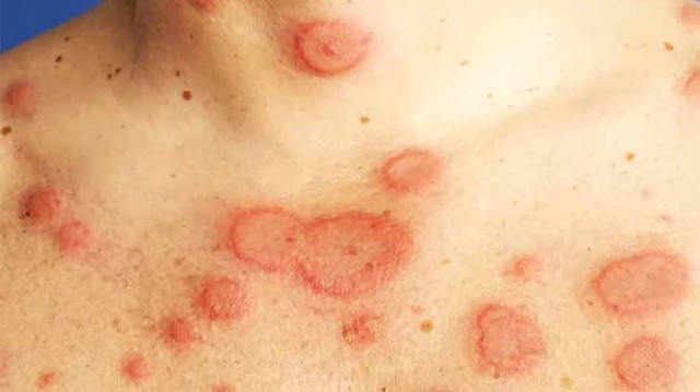 bai-viet/tong-quan-ve-benh-lupus-ban-do-dang-dia-55744.html