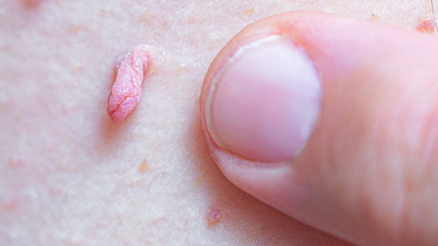 bai-viet/tong-quan-ve-sui-mao-ga-giai-doan-cuoi-trieu-chung-nguy-hai-va-cach-dieu-tri.html