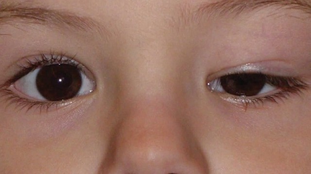 bai-viet/top-3-cach-tri-mat-to-mat-nho-don-gian-tai-nha-64448.html